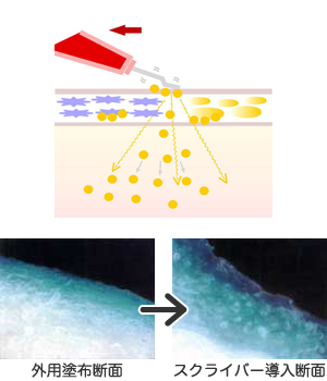 導入のイメージ図、画像：外用塗布断面→スクライバー導入断面